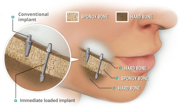 Conventional implants vs. Swiss implant system
