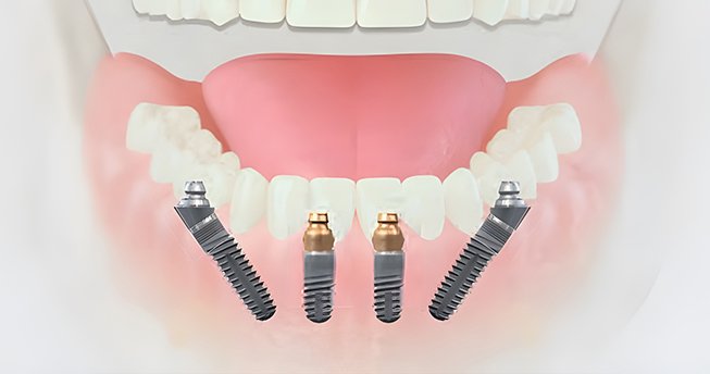 The Fast&Fixed™ implant system