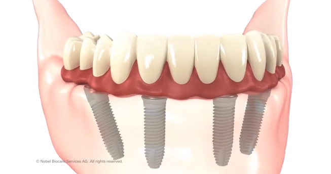 All-on-4 dental implant system