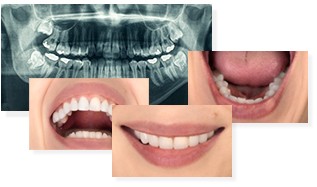 All-on-4 dental implant system - before and after